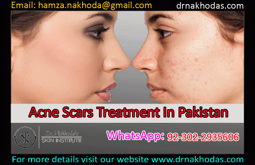 Get the most restorative, rejuvenating pampering with the latest acne scars treatment in Pakistan. Dr. Nakhoda’s Skin Institute helps you getting an acne-free, flawless, and more youthful appearance with advanced skin and acne treatments. Book your first consultations today.