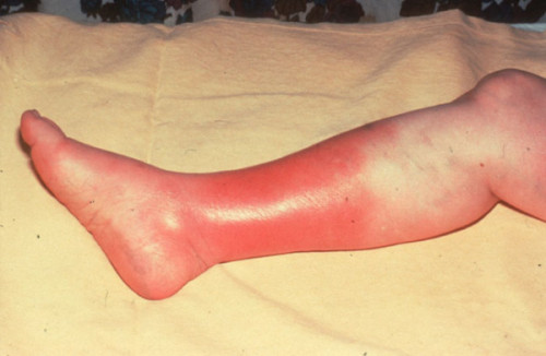 cellulitis.jpg