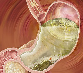 gastroparesis-1.jpg