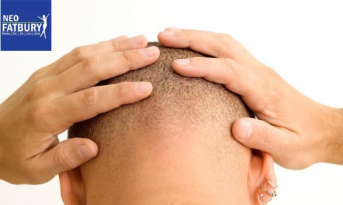 This treatment is done with your own hair. Some of your hair is removed through a surgery to fill in the portion with thin hair or no hair at all