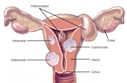 laparoscopic-myomectomy.jpg