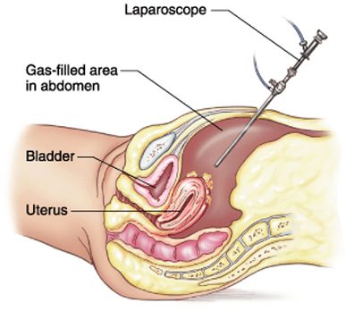 laparoscopy-treatment.jpg