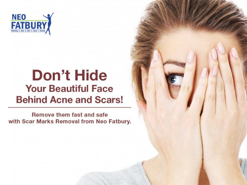 Neo Fatbury provides advanced Laser Acne Scar Removal Treatment in Hyderabad. Microdermabrasion is the most innovative age defying treatment to diminish the Scars.